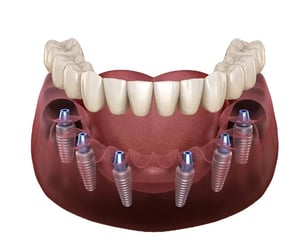 All-on-6-implants-in-turkey-1-webp