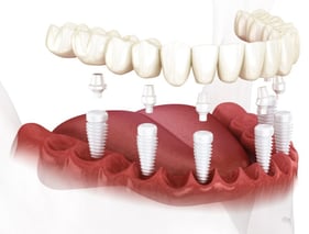 Zirconia-Implants-1024x683-1